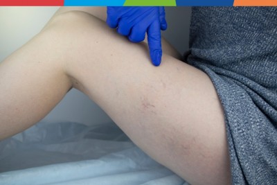 Scleroterapia: când este recomandată?